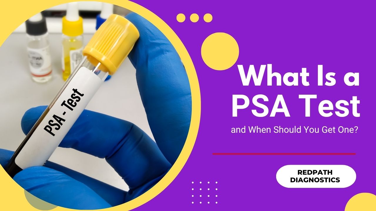 What Is a PSA Test and When Should You Get One? – Redpath Diagnostics